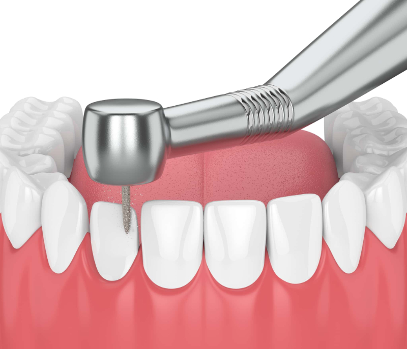 矯正治療で歯を削るイメージ