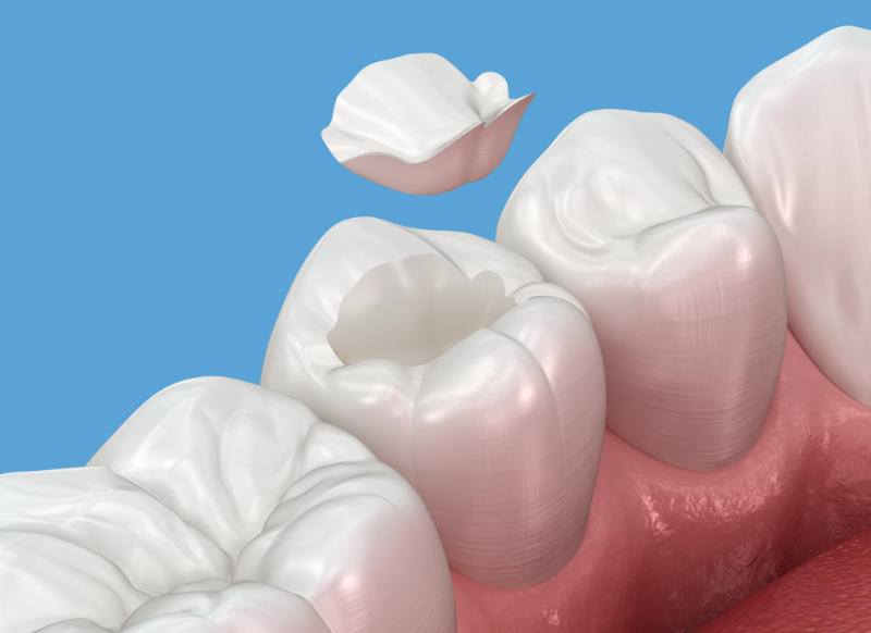 根管治療の仮蓋が外れたイメージ