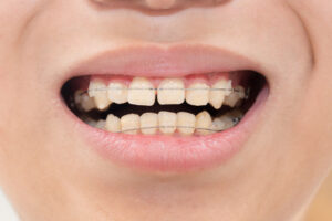 ワイヤー矯正をしている人の歯