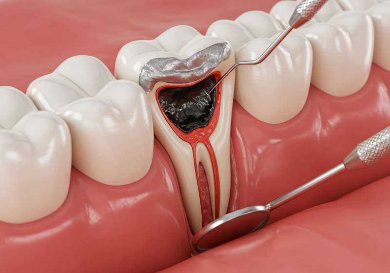 銀歯の下にできた虫歯
